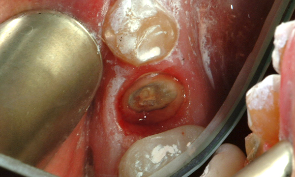 gingival festoon